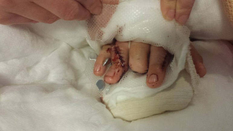 Dylan's hand after surgery